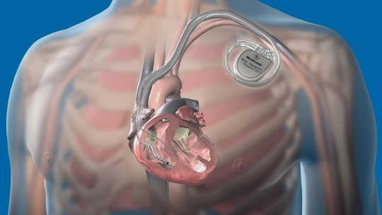 This Implant Predicts Heart Failure A Month Before It Happens