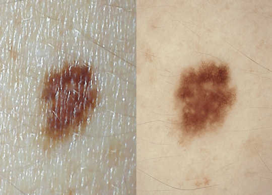  A dermoscope helps your doctor see if your mole has hidden melanoma signs, or if it’s nothing to worry about. UQ