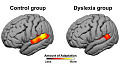 Brains Of People With Dyslexia Don’t Adapt To New Stuff