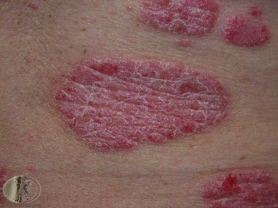 Psoriasis lesions are raised, red and often have white scales.