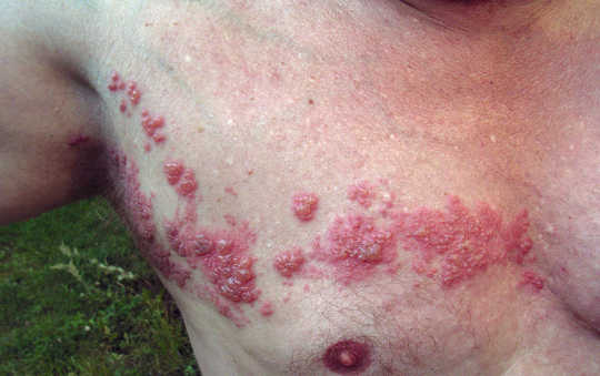 Shingles forms a painful, blistered red rash along the line of a sensory nerve.