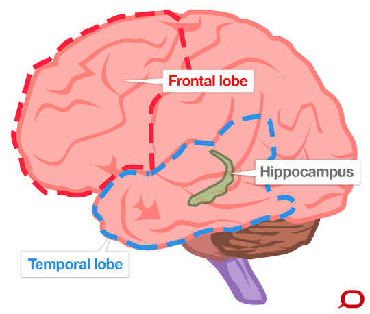 Why people with dementia do not all behave the same: The frontal lobe, temporal lobe and hippocampus can all be affected by different types of dementia. 