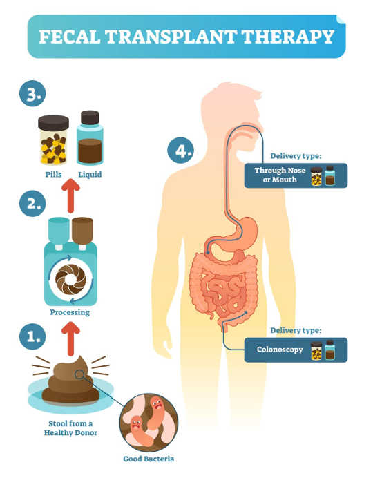 Fecal Microbiome Transplantation Shows Promise In Treating Colitis