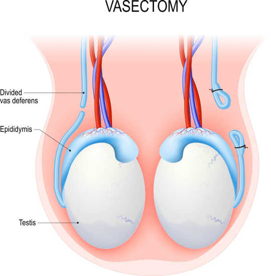 is Vasectomy reversible2 2 22