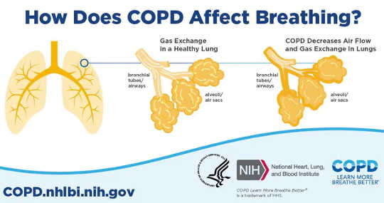 How Cigarette Smoke Causes Copd To Hang On After Smoking Ends