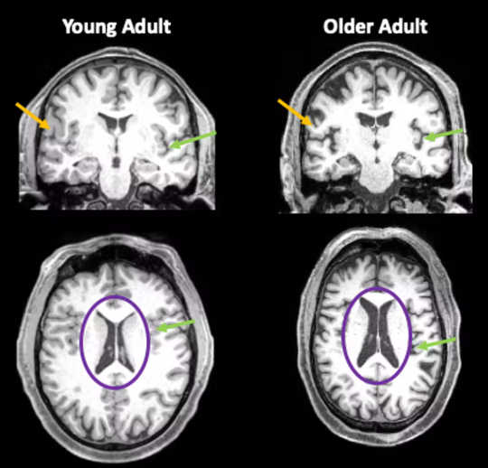covid linked to brain shrinkage